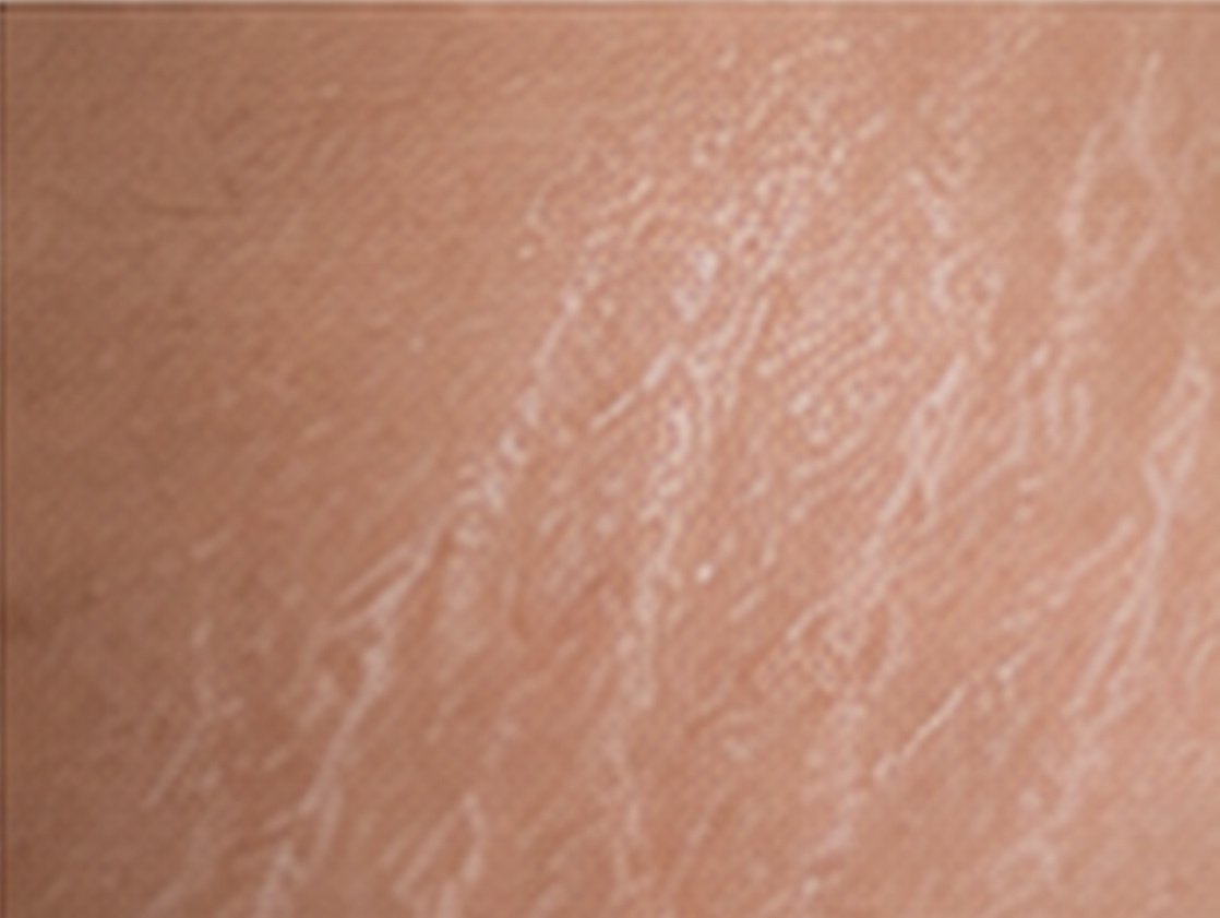 Illustrative Stretch Marks Microneedling service image